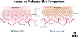 Melasma vs Normal skin