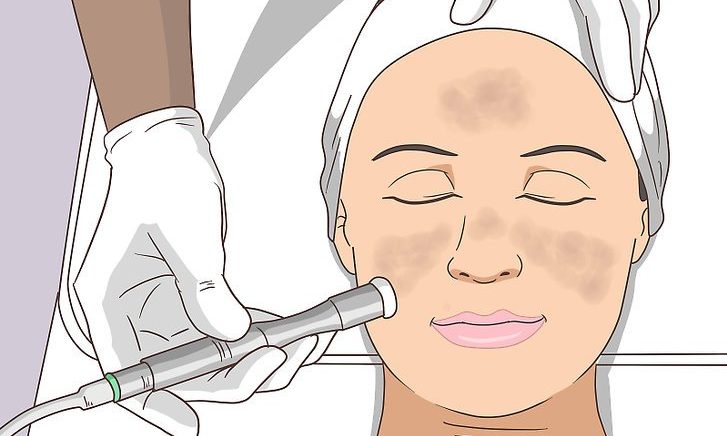 Treating Melasma