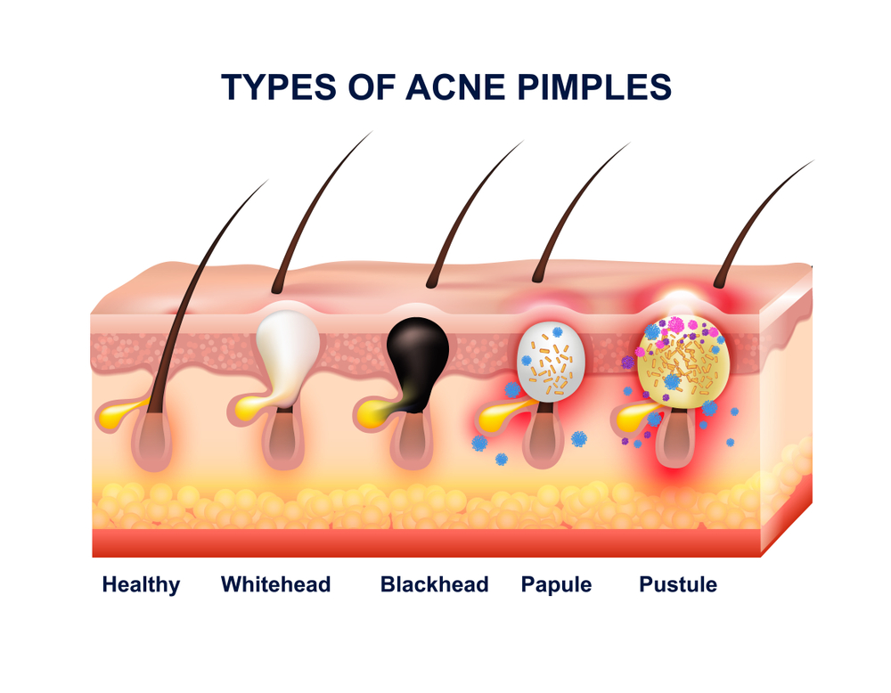 causes of acne