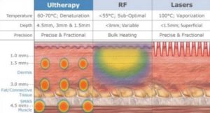 HiFu vs Thermage